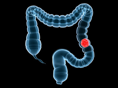 Obesity_and_Colon_Cancer_Scan_Blog_May09.jpg