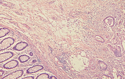 colon_cancer_scan_blog_Apr09.jpg