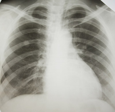lung_cancer_medication_scan_blog_April09.jpg
